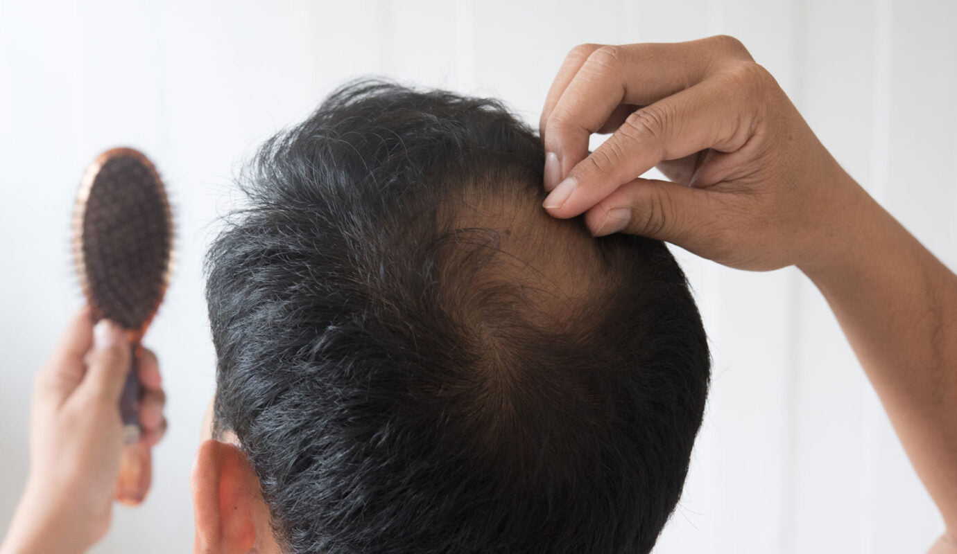 Hair Fall Prevention Through Natural and Ayurvedic Ways 2023