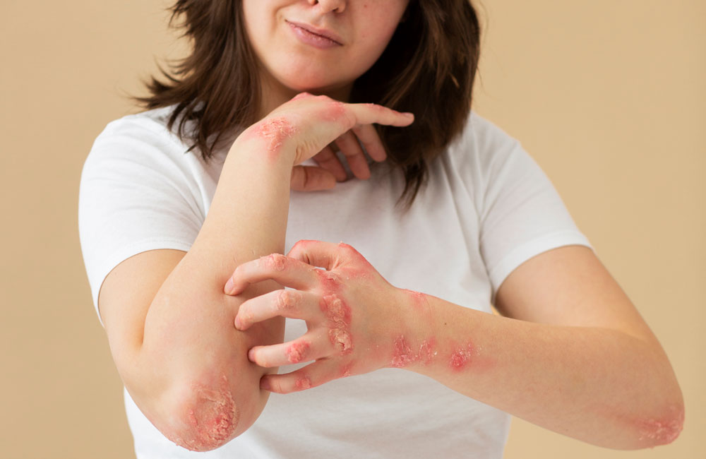 Understanding Psoriasis: Causes, Symptoms, and Effective Ayurvedic Treatments 2023